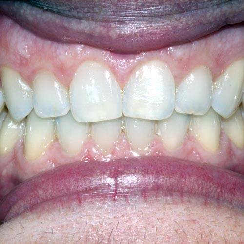 Después del tratamiento con Invisalign en All Dental Group