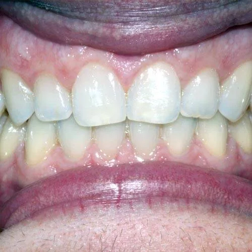 After Invisalign treatment at All Dental Group