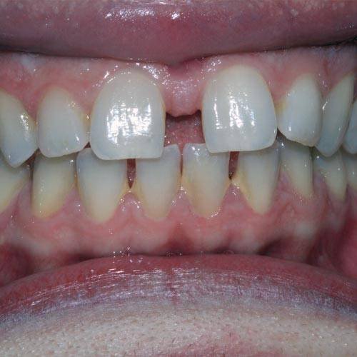 Antes del tratamiento con Invisalign