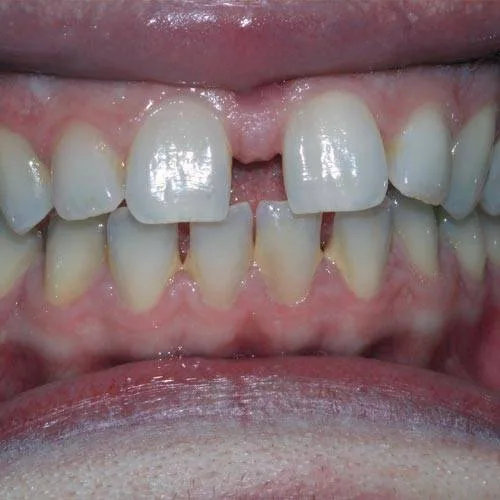 Before Invisalign treatment