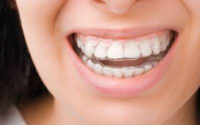 What You Need to Know Before Getting Invisalign