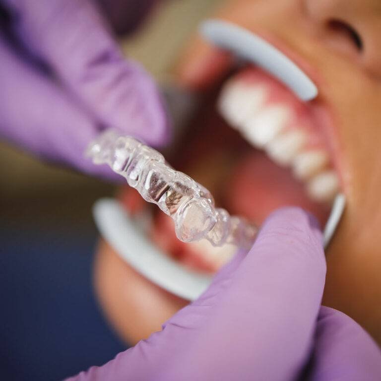 Dentist placing a clear aligner — will Invisalign work for me?