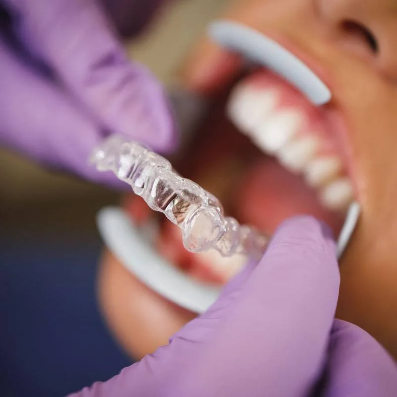 Clear Invisalign aligner being fitted
