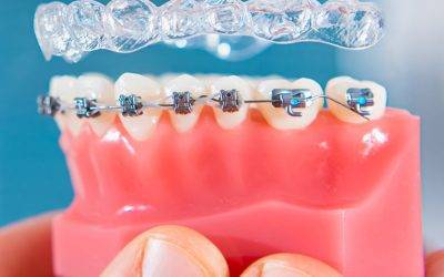 Can you do Invisalign with implants?