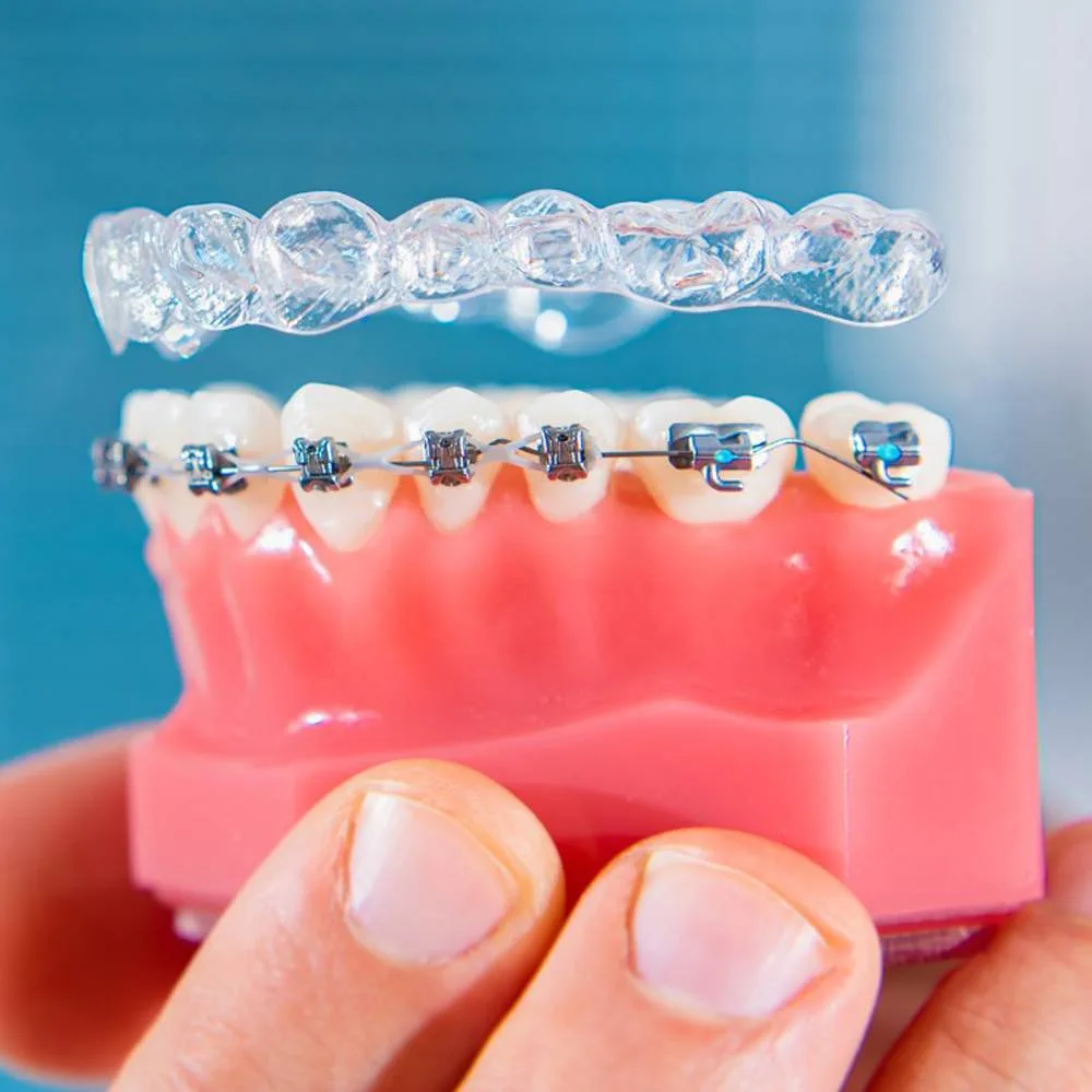 Clear aligner and braces on a dental model — can you do Invisalign with implants?