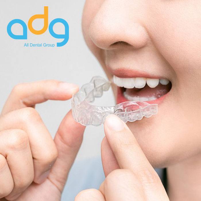 Do you have to wear a retainer forever after Invisalign - All Dental Group Dentist in Miami Lakes FL